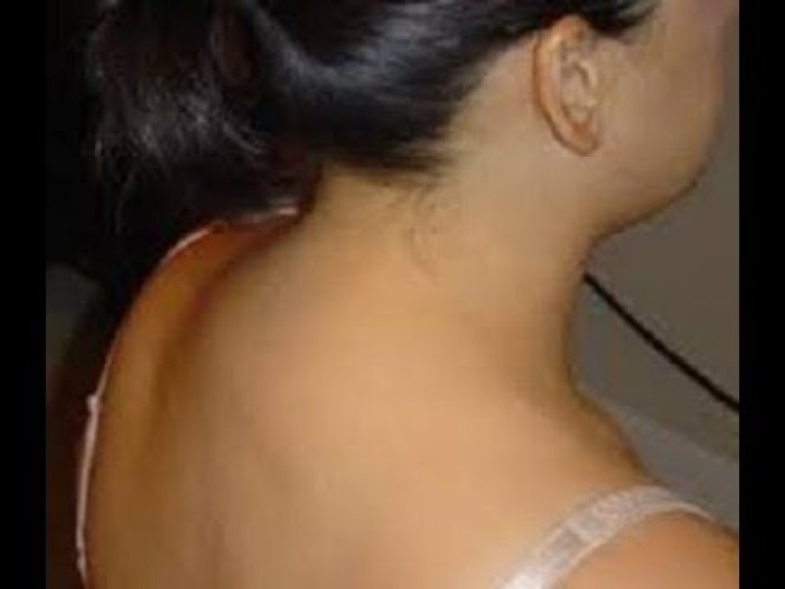 كيف نتخلص من حدبة الرقبة المزعجة؟