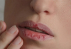 ما الذي يؤدي الى استمرار المعاناة من تشققات الشفاه؟
