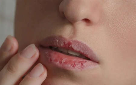 ما الذي يؤدي الى استمرار المعاناة من تشققات الشفاه؟