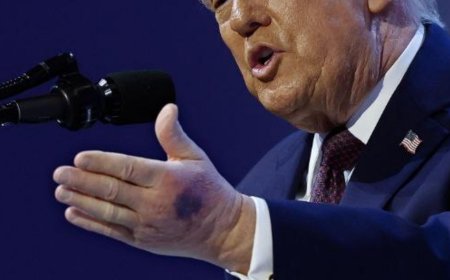 بالصورة.. ما سبب كدمة ترامب؟