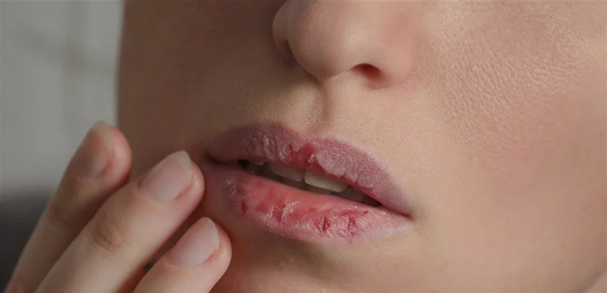 ما الذي يؤدي الى استمرار المعاناة من تشققات الشفاه؟