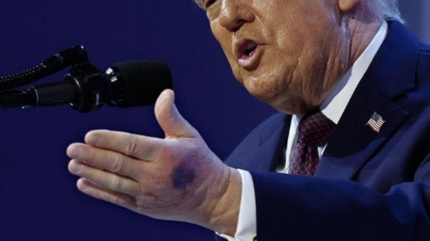 بالصورة.. ما سبب كدمة ترامب؟