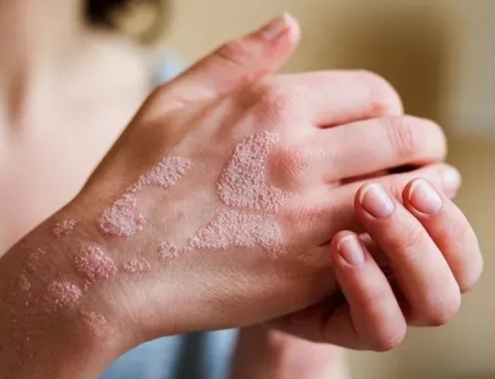 دراسة تكشف.. أطعمة تخفف من أعراض الصدفية