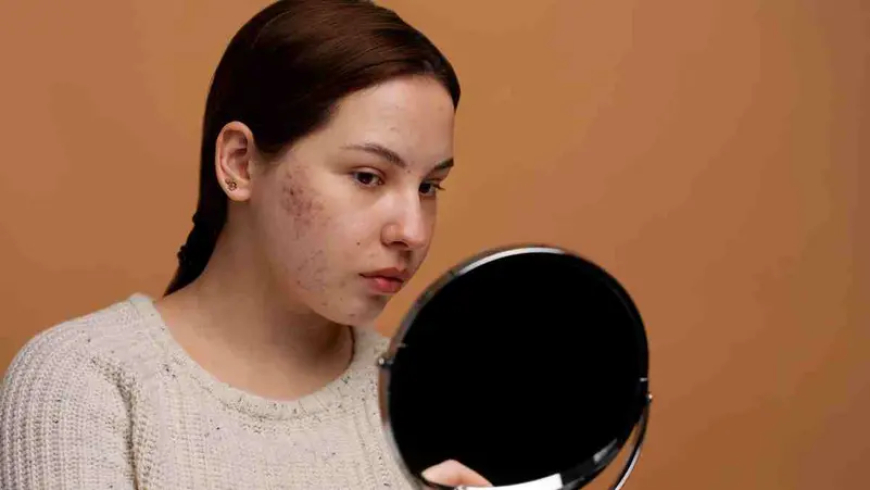 لماذا يكثر حب الشباب في الشتاء؟