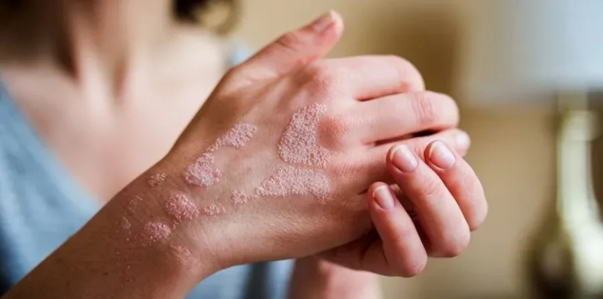 دراسة تكشف.. أطعمة تخفف من أعراض الصدفية