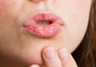 تشقق الشفاه في شهر رمضان.. اليكم الحلول