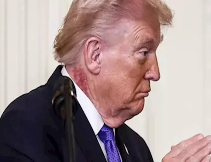 بقعة حمراء على رقبة ترامب تثير الجدل…