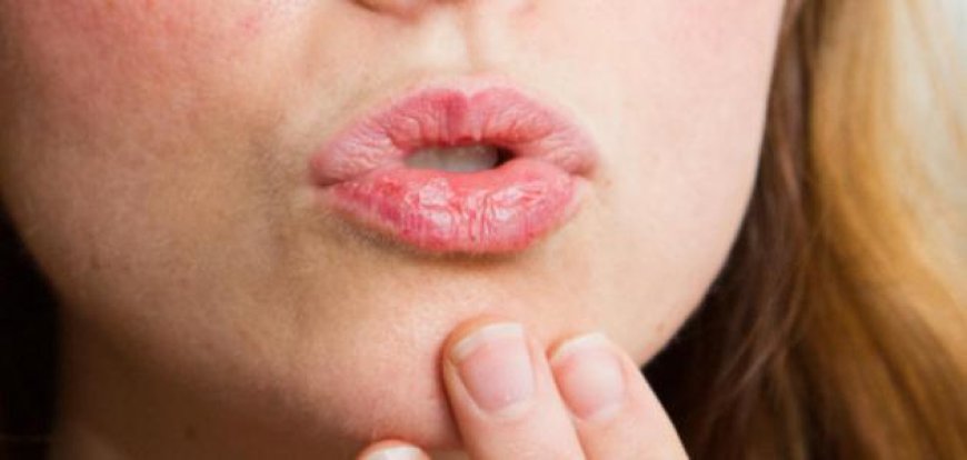 تشقق الشفاه في شهر رمضان.. اليكم الحلول